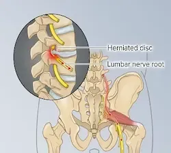 sta je isijas, manuelna terapija pravdic-beograd