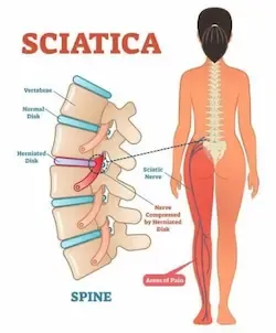 isijas uzroci, manuelna terapija pravdic-beograd