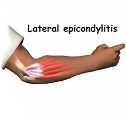 teniski lakat uzroci, manuelna terapija pravdic-beograd