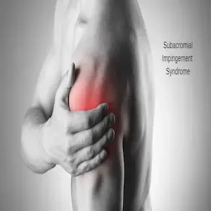 Impindzment ramena, manuelna terapija pravdic