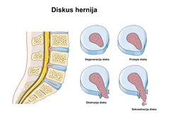 faze diskus hernije-manuelna terapija pravdic-beograd, terapija za diskus herniju