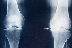 gonartroza lecenje, manuelna terapija pravdic-beograd