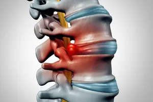 Diskus hernija, terapija za diskus herniju, rehabilitacija diskus hernije, manuelna terapija pravdic