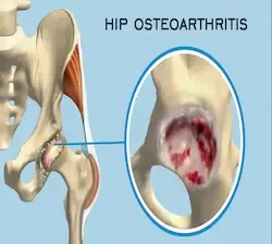 isijalgija, manuelna terapija pravdic-beograd