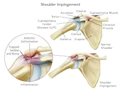 Kako se impindžment ramena razvija, manuelna terapija pravdic
