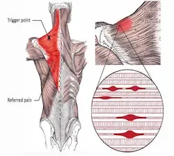 Sta je triger point, manuelna terapija pravdic